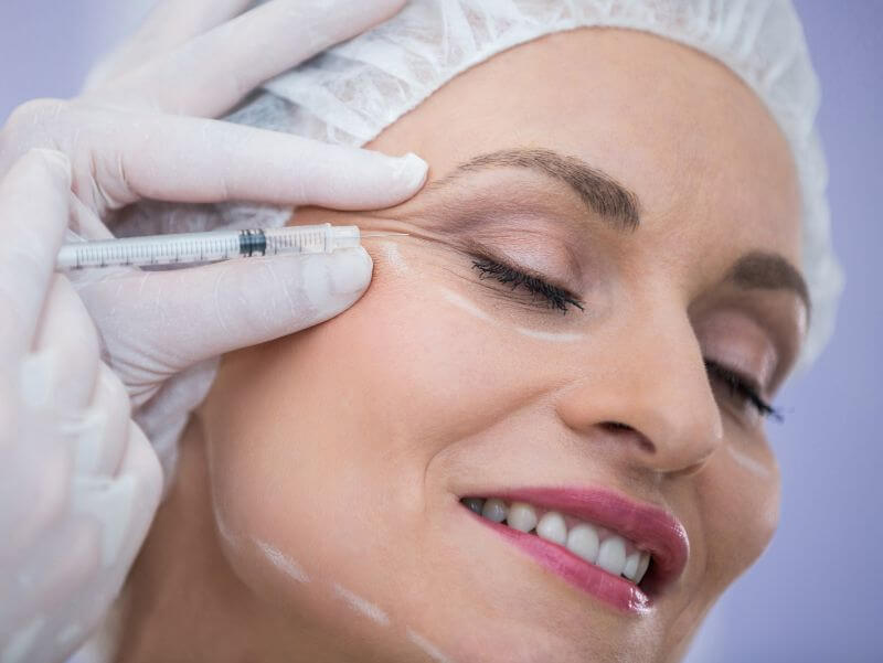 Botox ενέσεις σε μεσήλικο γυναικείο πρόσωπο, αναδεικνύοντας τη λείανση των ρυτίδων και τη νεανική αναζωογόνηση.